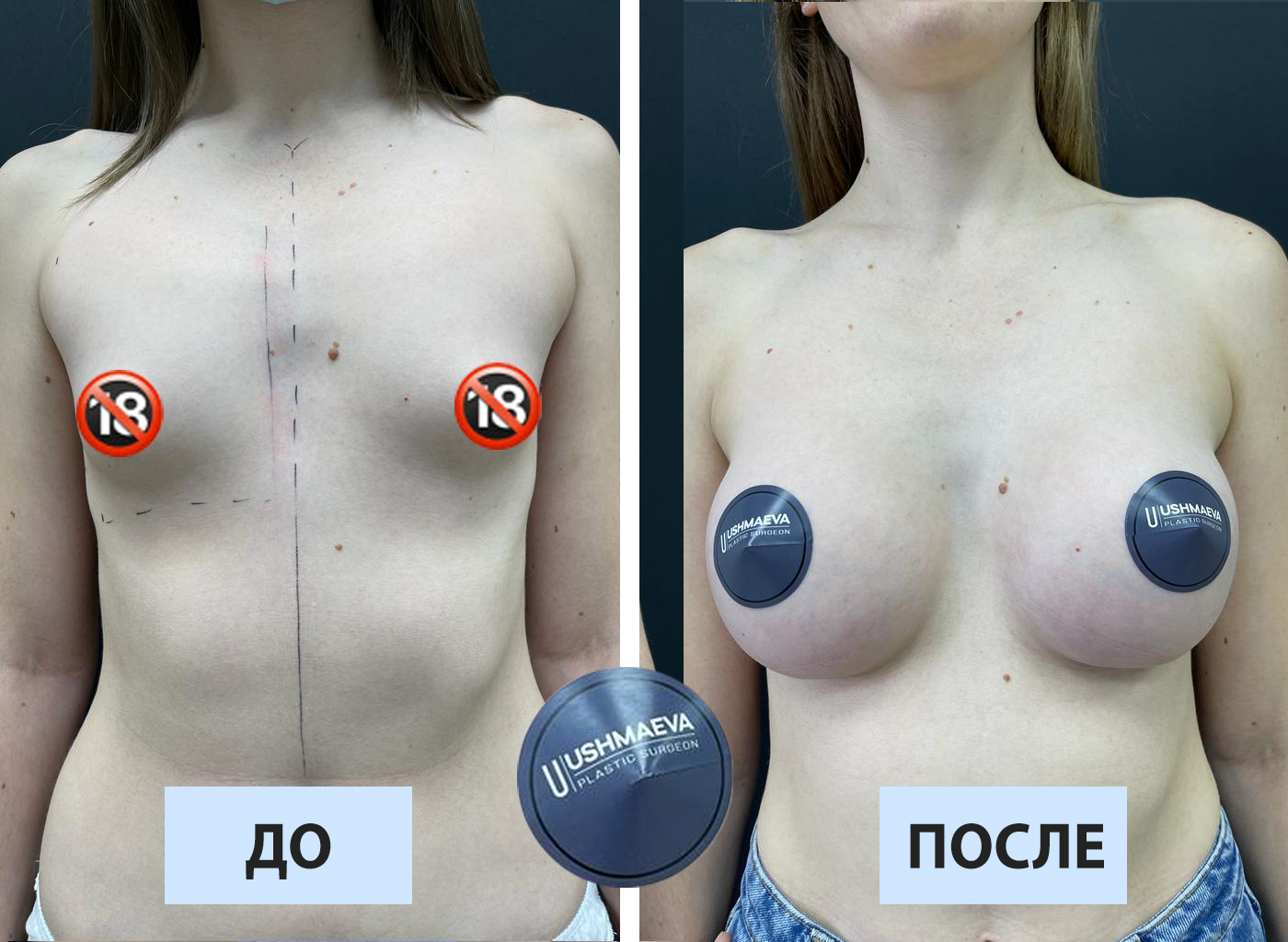 Увеличение груди имплантами
